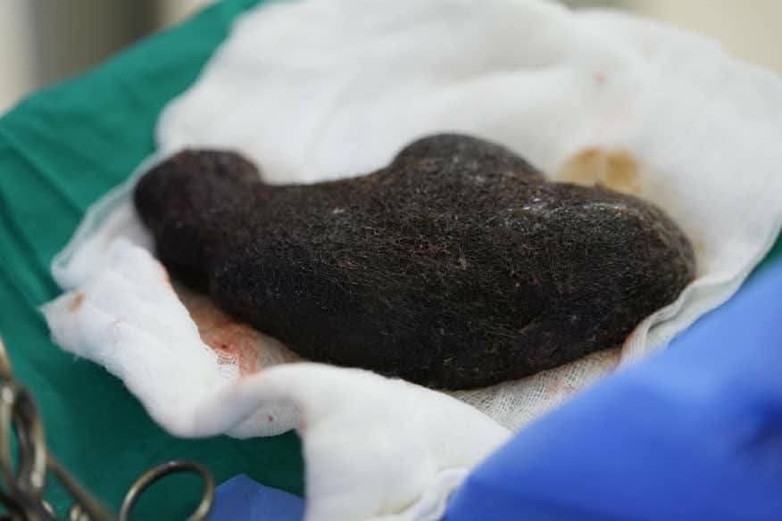 إنجاز طبي نادر.. استخراج كيلو من الشعر من معدة طفلة في مستشفى الدبة